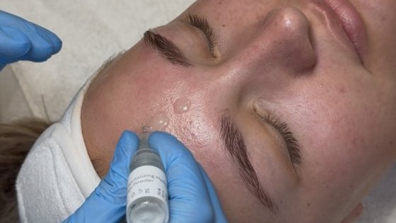 SQT Bio Microneedling